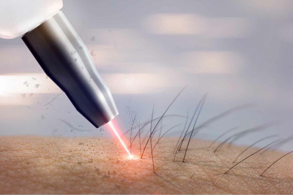All You Ever Wanted to Know About Laser Hair Removal Nyc