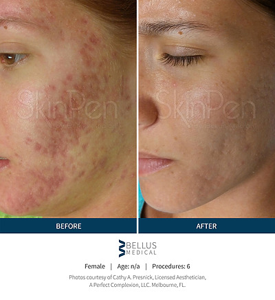 Before & after_image_Microneedling NYC-service-page_manhattanlaserspa-one