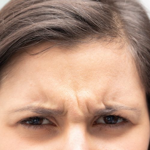 Hairline – 1 session