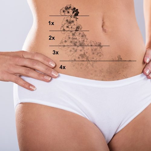 Laser tattoo-removal – 4 sessions for a small area up to 3×3 inches