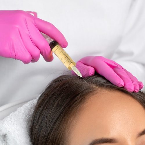 PRP for hair growth/hair loss/hair restoration – 1 procedure