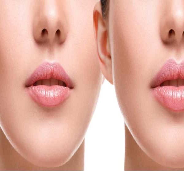 1 syringe of Juvederm Voluma