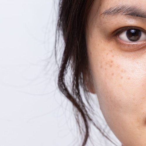 Sun spot/age spot/freckles removal – 1 session