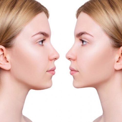 Coolsculpting. Mini/Double chin – 1 session