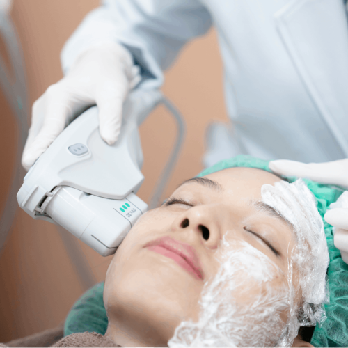 Ultherapy – Full Face