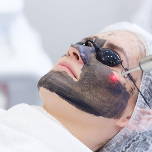 Carbon Laser Facial – 1 session