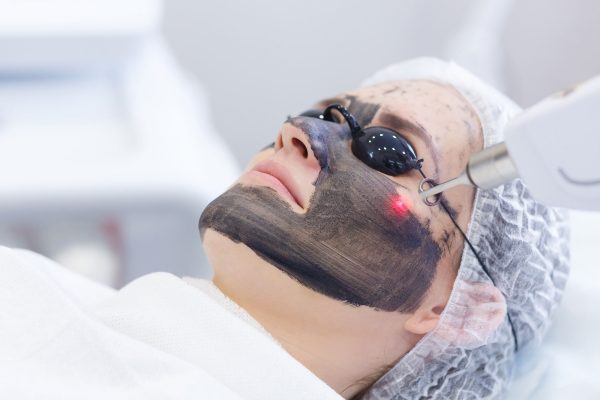 Carbon Laser Facial – 1 session