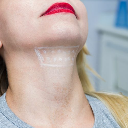 Kybella