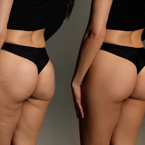 RADIESSE Non-Surgical Butt Lift – 20 Syringes