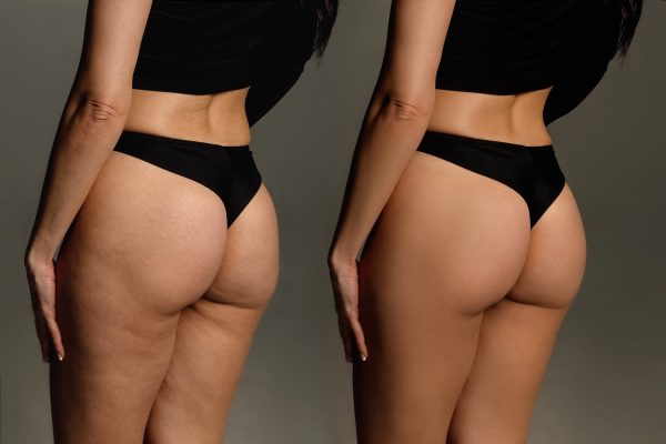 RADIESSE Non-Surgical Butt Lift – 8 Syringes