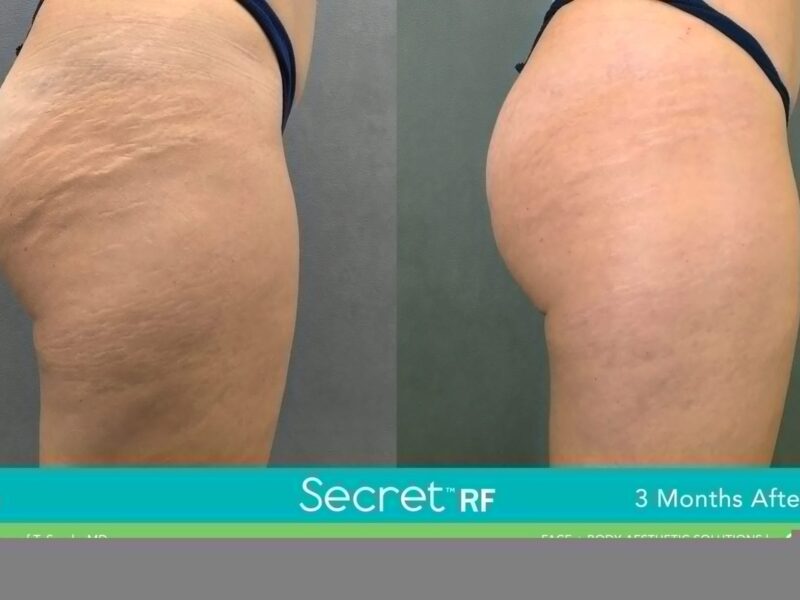Before-&-After_Images_RF-Microneedling-service_manhattanlaserspa-five