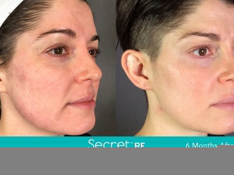 Before-&-After_Images_RF-Microneedling-service_manhattanlaserspa