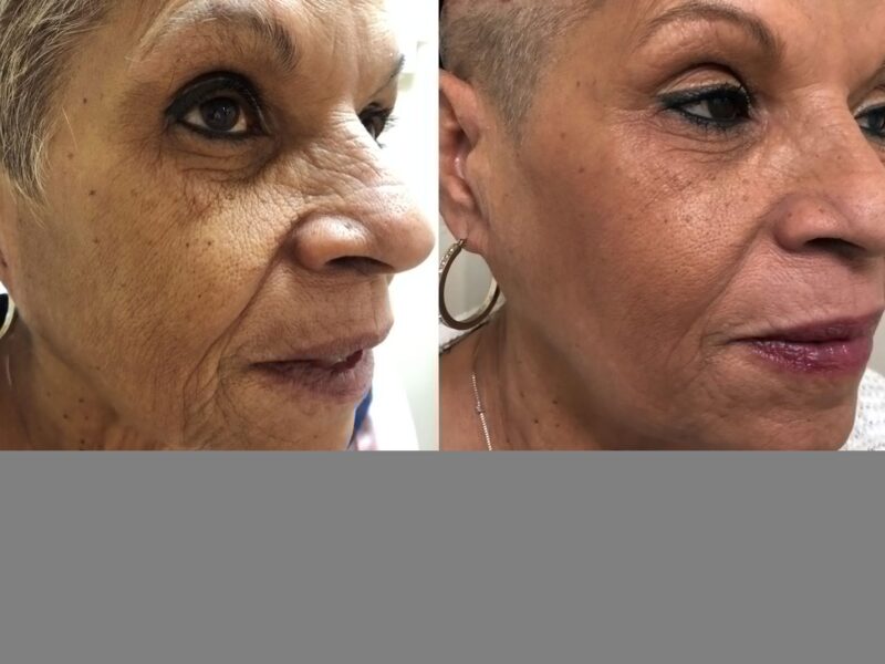 Before-&-After_Images_RF-Microneedling-service_manhattanlaserspa-three